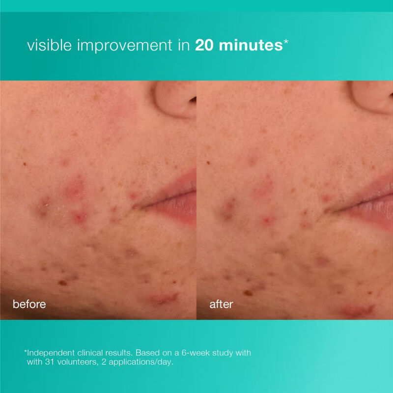 Dermalogica Acne Biotic Moisturizer image number 1