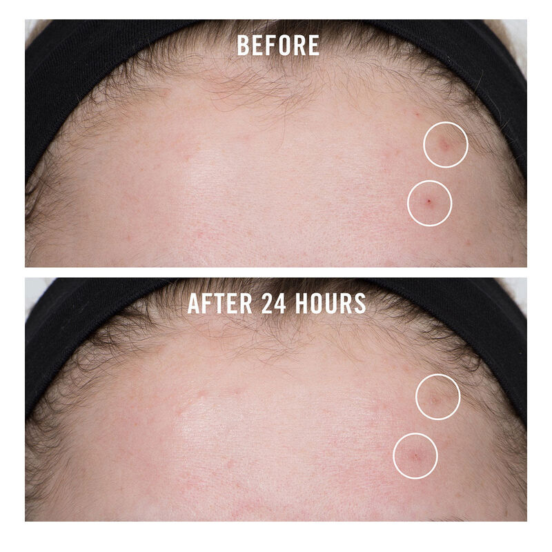 First Aid Beauty FAB Pharma BHA Acne Spot Treatment Gel 2% Salicylic Acid image number 2