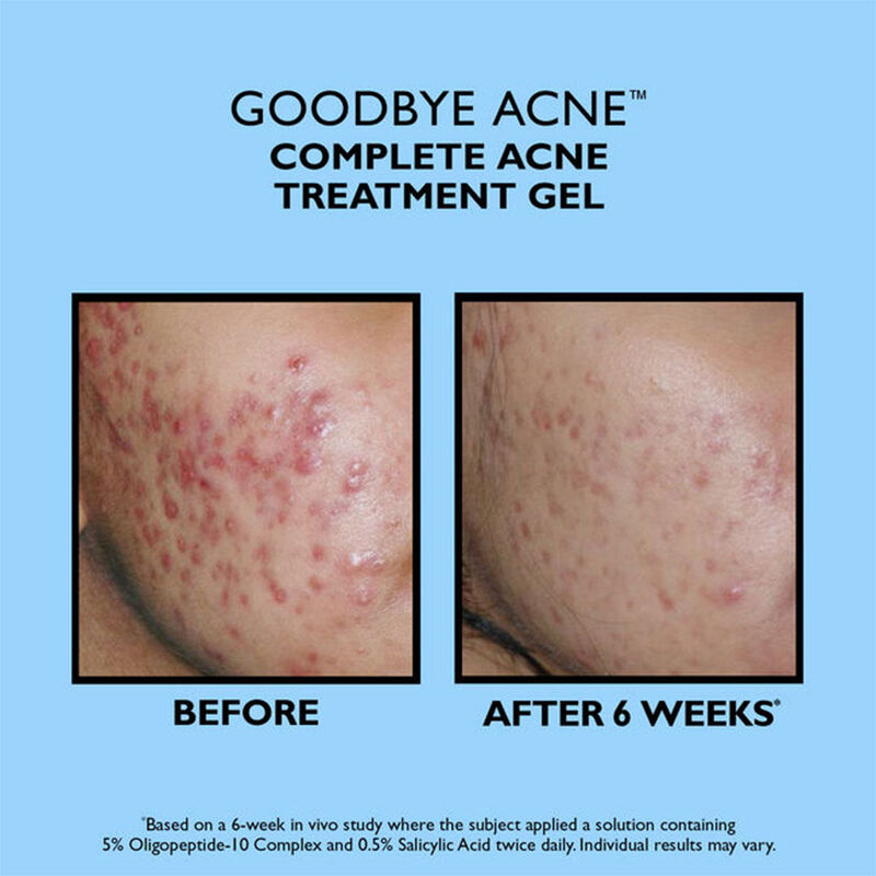 Peter Thomas Roth Full-Size Goodbye Acne Treatment Pair image number 2